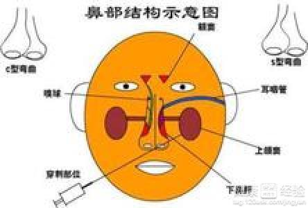 鼻竇炎有哪些癥狀用什么藥治療