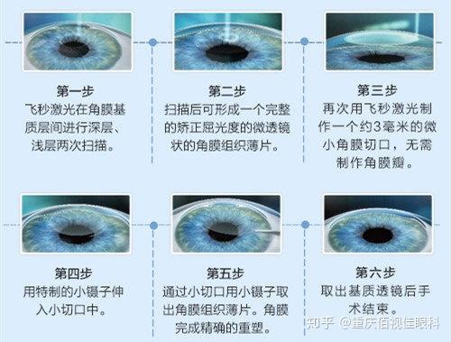 激光手術(shù)飛秒和全準激光的區(qū)別