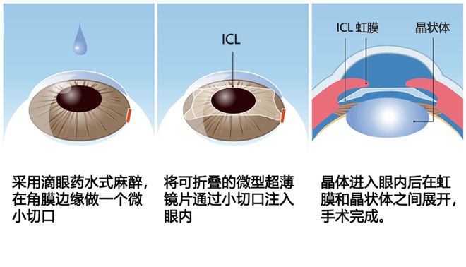 晶體植入近視手術(shù),晶體植入近視手術(shù)與結(jié)構(gòu)化推進(jìn)評估，未來的眼科醫(yī)療革新,專業(yè)研究解釋定義_升級版17.51.59