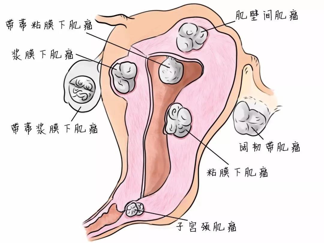 子宮肌瘤咨詢免費(fèi)專家,子宮肌瘤咨詢免費(fèi)專家，深度解析與數(shù)據(jù)執(zhí)行研究,創(chuàng)新策略解析_云端版21.84.98