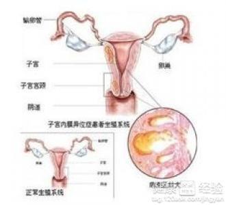 子宮內(nèi)膜異位癥（Endometriosis）是一種常見(jiàn)的婦科疾病，其中子宮內(nèi)膜細(xì)胞生長(zhǎng)在子宮外部，可能導(dǎo)致疼痛、不適和其他癥狀。關(guān)于全球有多少婦女患有子宮內(nèi)膜異位癥，數(shù)據(jù)可能會(huì)有所不同，但據(jù)某些來(lái)源估計(jì)，全球約有1.9億婦女患有這一疾病。，請(qǐng)注意，這些數(shù)據(jù)可能因不同的研究、統(tǒng)計(jì)方法和人口結(jié)構(gòu)而有所變化。如果您或您認(rèn)識(shí)的人有相關(guān)的健康疑慮，建議咨詢專業(yè)醫(yī)生以獲取準(zhǔn)確的診斷和治療建議。同時(shí)，對(duì)于女性而言，定期進(jìn)行婦科檢查并了解自己的身體狀況是非常重要的。