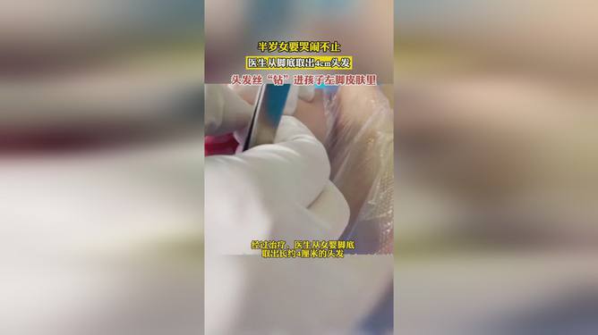 女嬰兩天哭鬧不止竟頭發(fā)絲繞腳趾